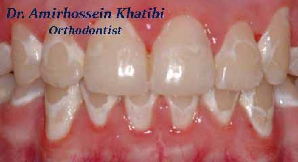 پوسیدگی دندان در ارتودنسی