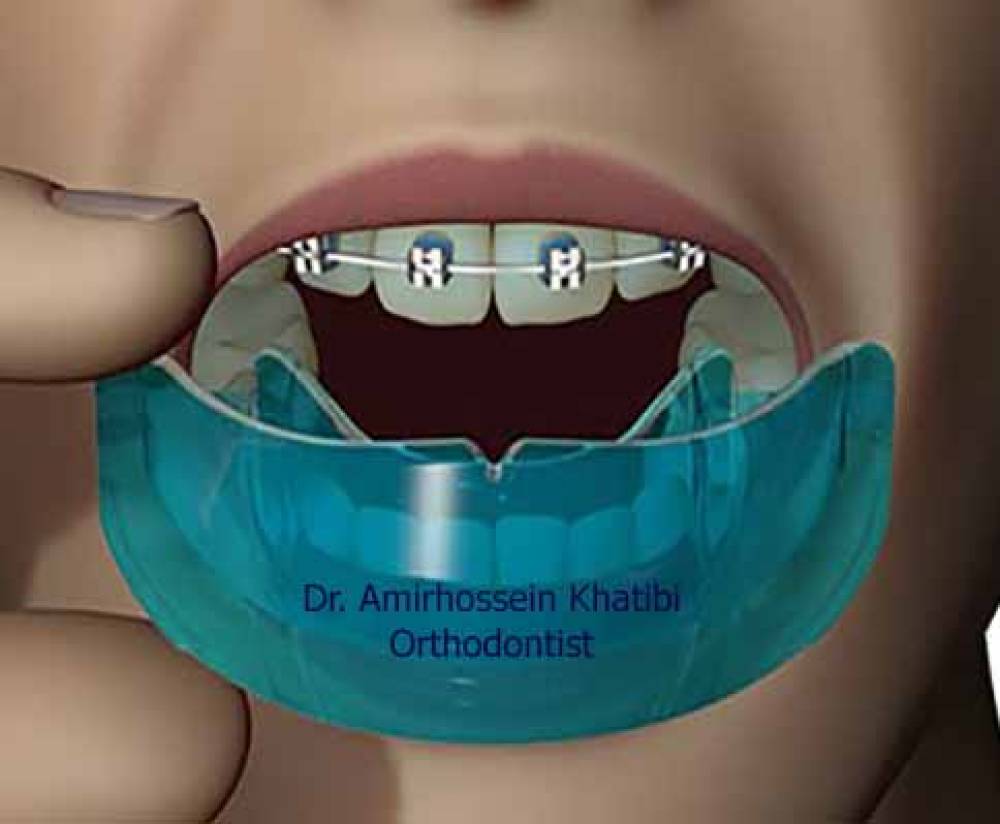 ارتودنسی و ورزش