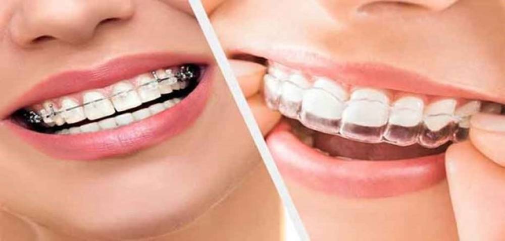 ارتودنسی نامرئی و ثابت در رباط کریم